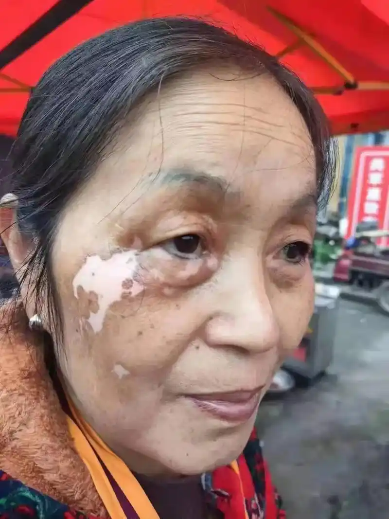 #皮肤问题 白癜风 - 抖音