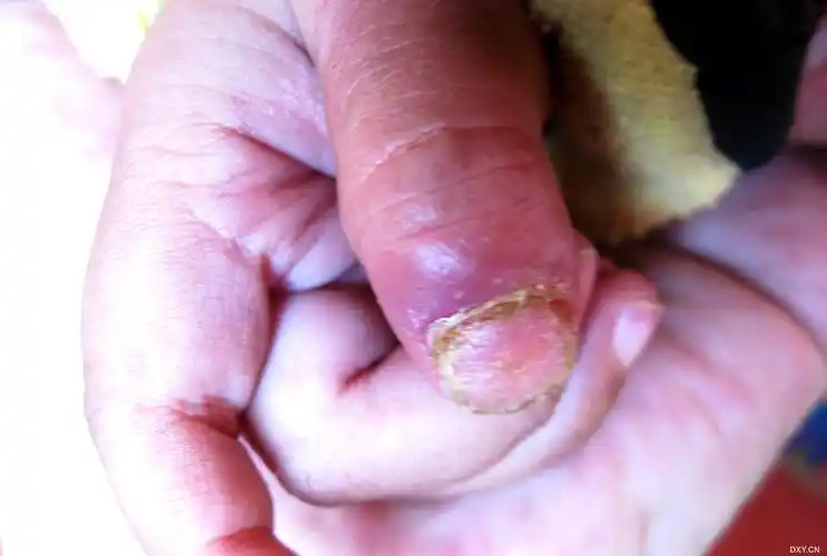 我儿子,15月大,双手拇指指甲变形周围红肿两月,如图,想请问大家诊断是