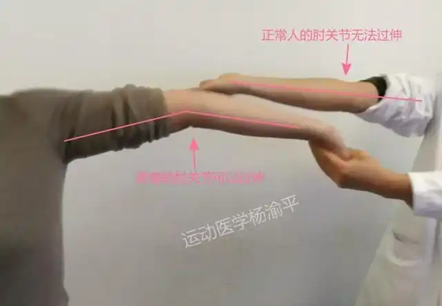 你的关节"松"了吗?自己在家测一测_症状