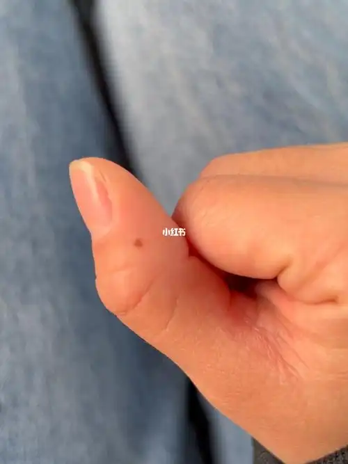 集美们 右手大拇指上出现了爱心痣  有什么说法吗?