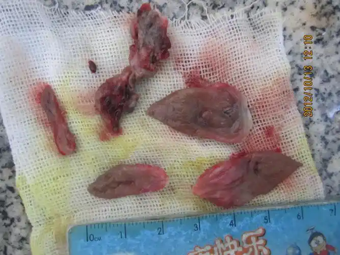 第四十一例环状混合痔术前术中术后及逐渐愈合图片集