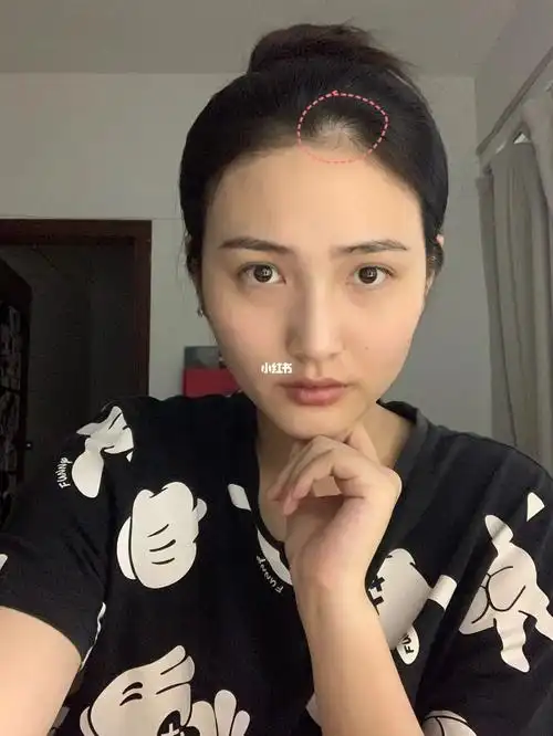 敢问发际线秃一块要如何拯救