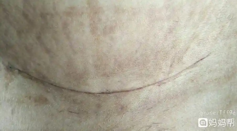 帮忙看看剖腹产二十一天的伤口恢复的怎么样啊,感觉我的刀口开的好长