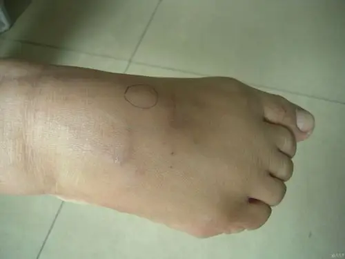 脚背这块凸起的是什么