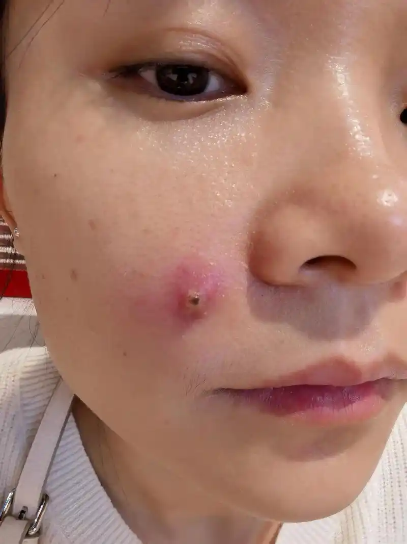 磨死人的疖子,自己捅了下医生说危险三角区,位置连通