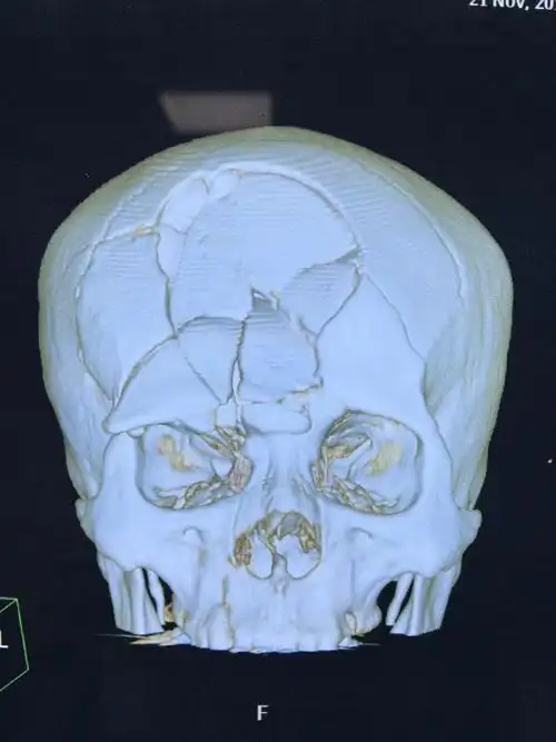 术前颅骨三维重建