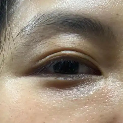 眼周细纹?眼周手针了解一下