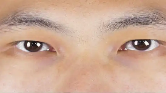 长撅眼怎么治疗_民福康