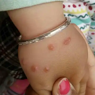 最近几天胳膊上出了好多这种水泡,昨天去医院医生说疱疹性病毒感染,给