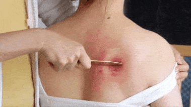 "_刮痧_乳房_位置