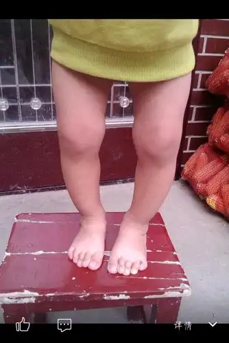 问:宝宝两岁了,o型腿,怎么矫正?