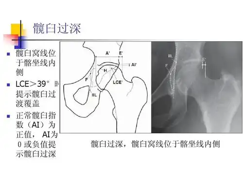 髋臼过深,髋臼窝线位于髂坐线内侧