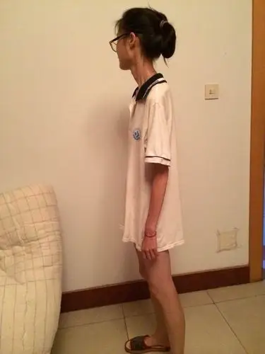 女孩节食减肥瘦成衣架吃中药后绝经