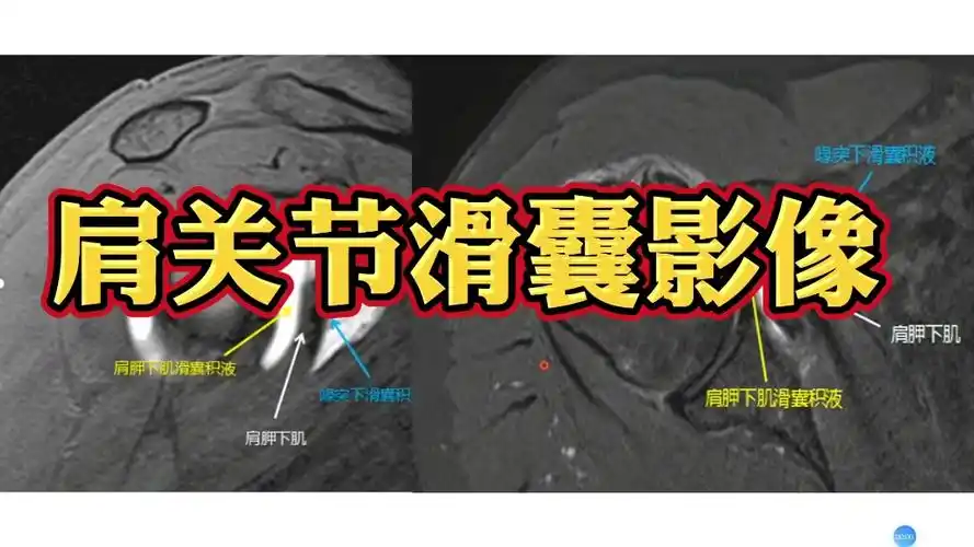 影像基础:肩胛下肌滑囊和喙突下滑囊积液如何区分?简单实用!