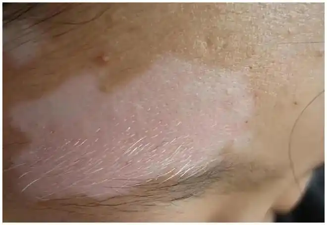 白斑|皮肤疾病|白斑病|治疗_网易订阅