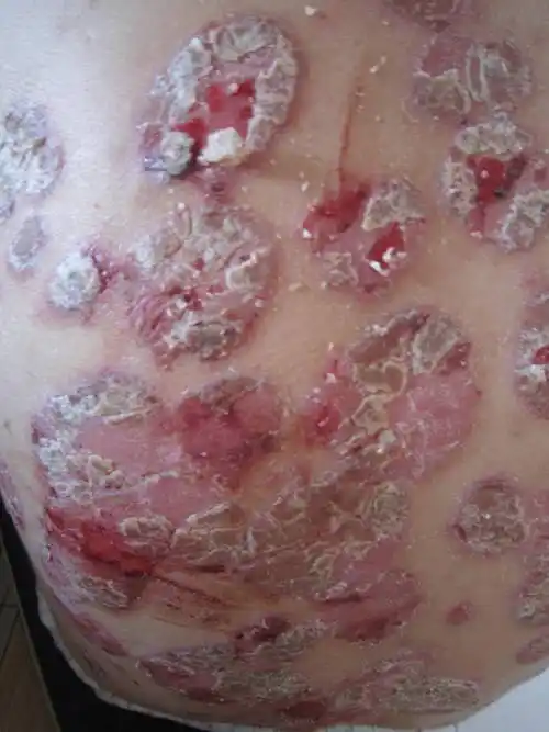 牛皮癣初期的症状与我的痊能之路_生活_生命_身体