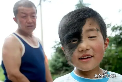 可怜的8岁小孩右脸长满黑毛