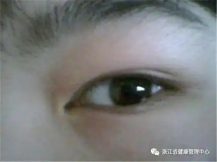 2水肿有可能是某些疾病的征兆除了眼睛肿,可能有时还会出现下肢肿胀或