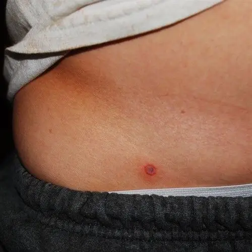 那可能是蜱虫了. 伤口描述一下.额,被咬多长时间了?