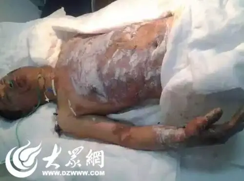 山东日照一家4口在家吃火锅发生爆炸 2人性命堪忧