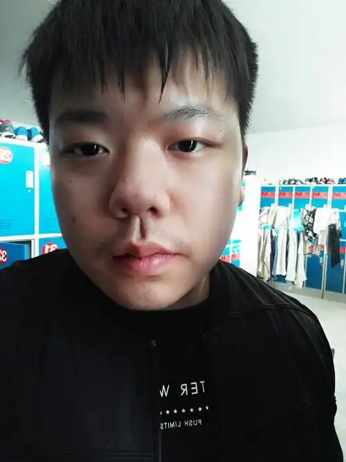 是蒜头鼻吗?我现在体重230斤 要是瘦下去鼻形会发生变化吗