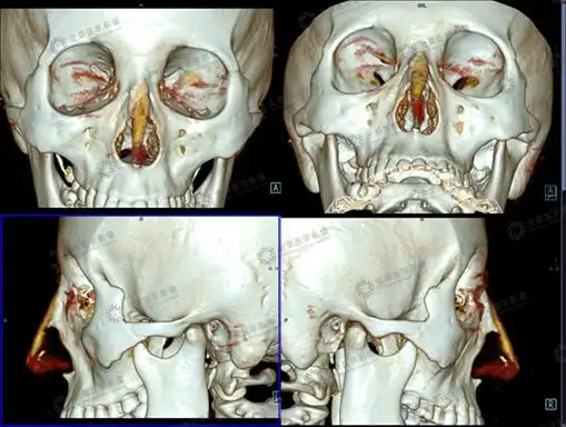 多层螺旋ct三维重建在鼻骨下颌骨整形中的应用