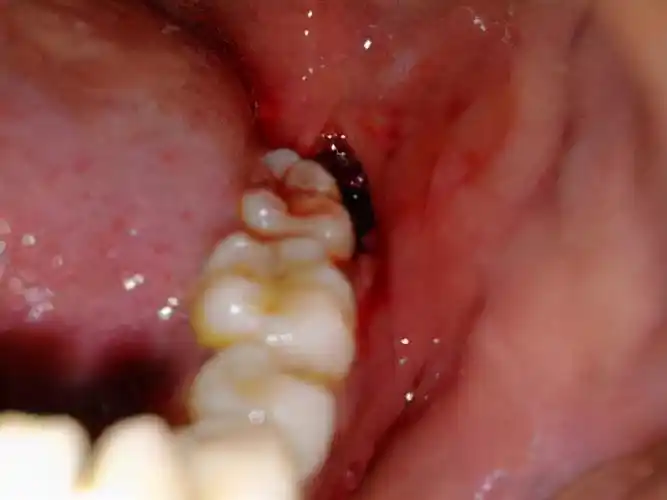 女子智齿发炎,导致脸颊烂穿!一旦出现这6个症状,赶紧看医生