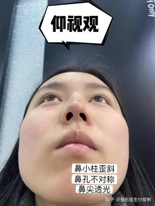 鼻修复术后28天歪鼻小柱终于扳正