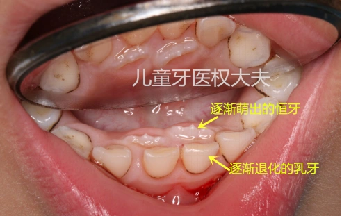 正常情况下,恒牙胚位于乳牙根的靠近舌头的那一侧,恒牙在萌出过程中