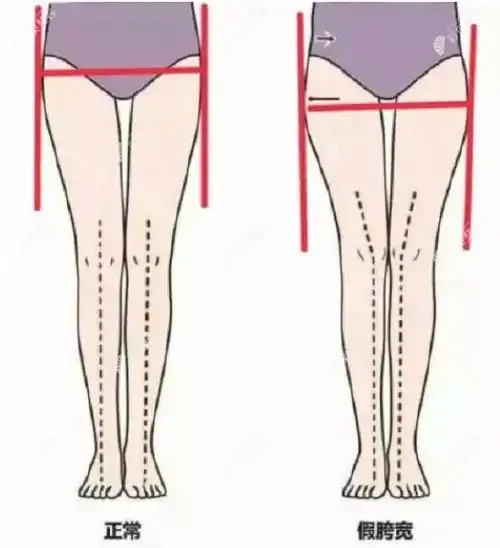 假胯宽对比图