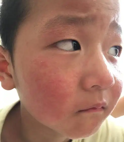 面部皮疹6小时
