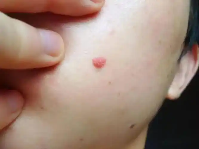 这些小疙瘩暗示肿瘤来临速看