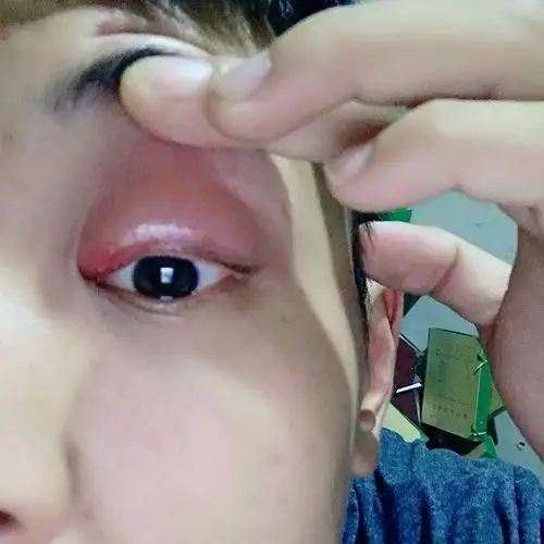 眼睛肿成这样怎么回事?