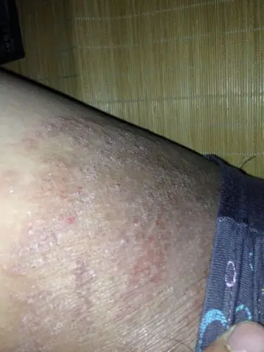 有脱皮现象和起小痘子,白天痒的难受,晚上疼的难受,有人说这是股癣