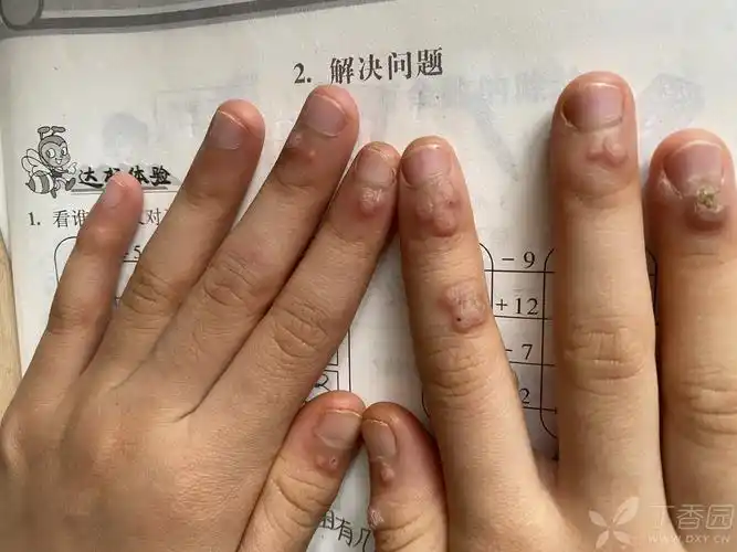 请问小孩的手指皮肤 [病例帖]