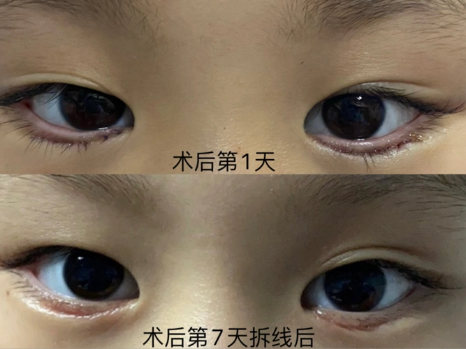睫毛长长,眼睛眨啊眨_倒睫_介绍_症状表现_治疗方式_日常注意事项