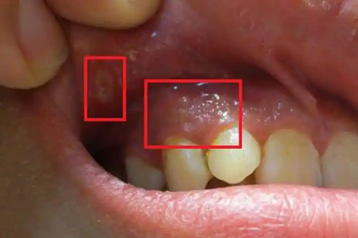 疱疹性龈口炎症状图