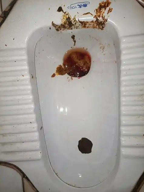 1,拉屎拉出血无疼痛鲜红色最常见的原因为内痔.