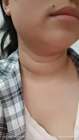 这个像大脖子病吗甲亢?