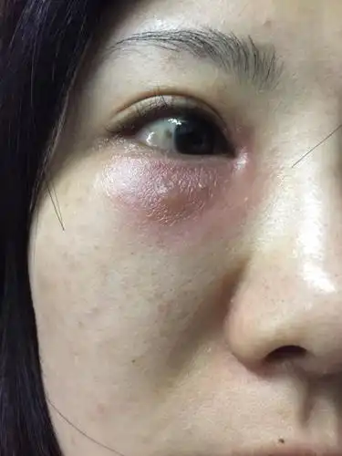 问:昨天中午饭后眼周痒揉眼后周围皮肤出现了红肿瘙痒眼内分泌物黄色