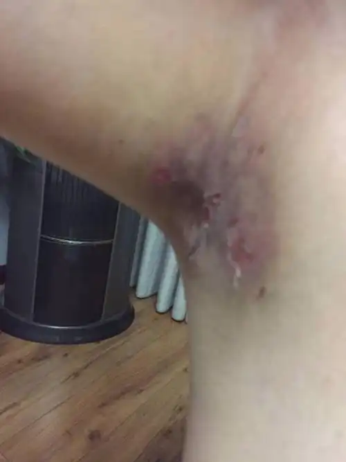 请问腋臭手术第十天变这样了该怎么办