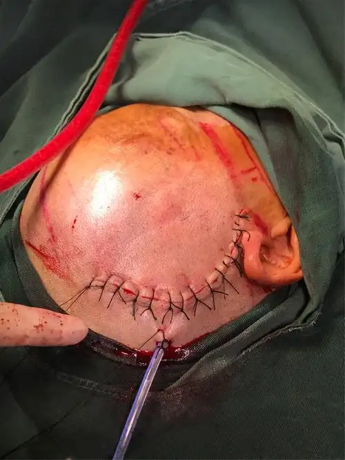 并且预留开颅切口线,如果微创遇到困难,立即中转开颅,保障手术安全