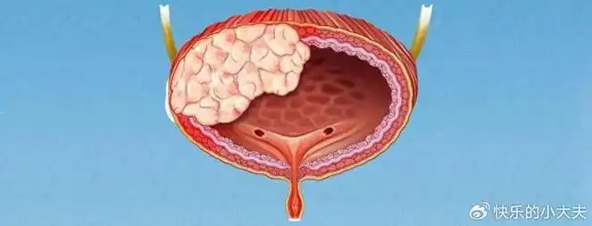 医生提醒:出现5个症状,快去做膀胱镜|膀胱癌|膀胱|膀胱镜_新浪新闻