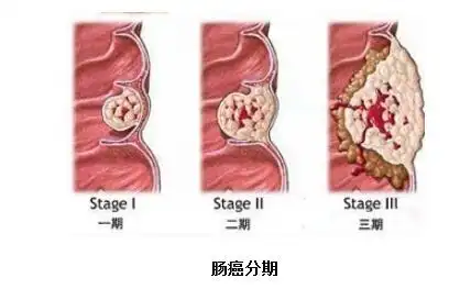 大便变细变扁次数增多可能是直肠癌排便习惯改变要留心图