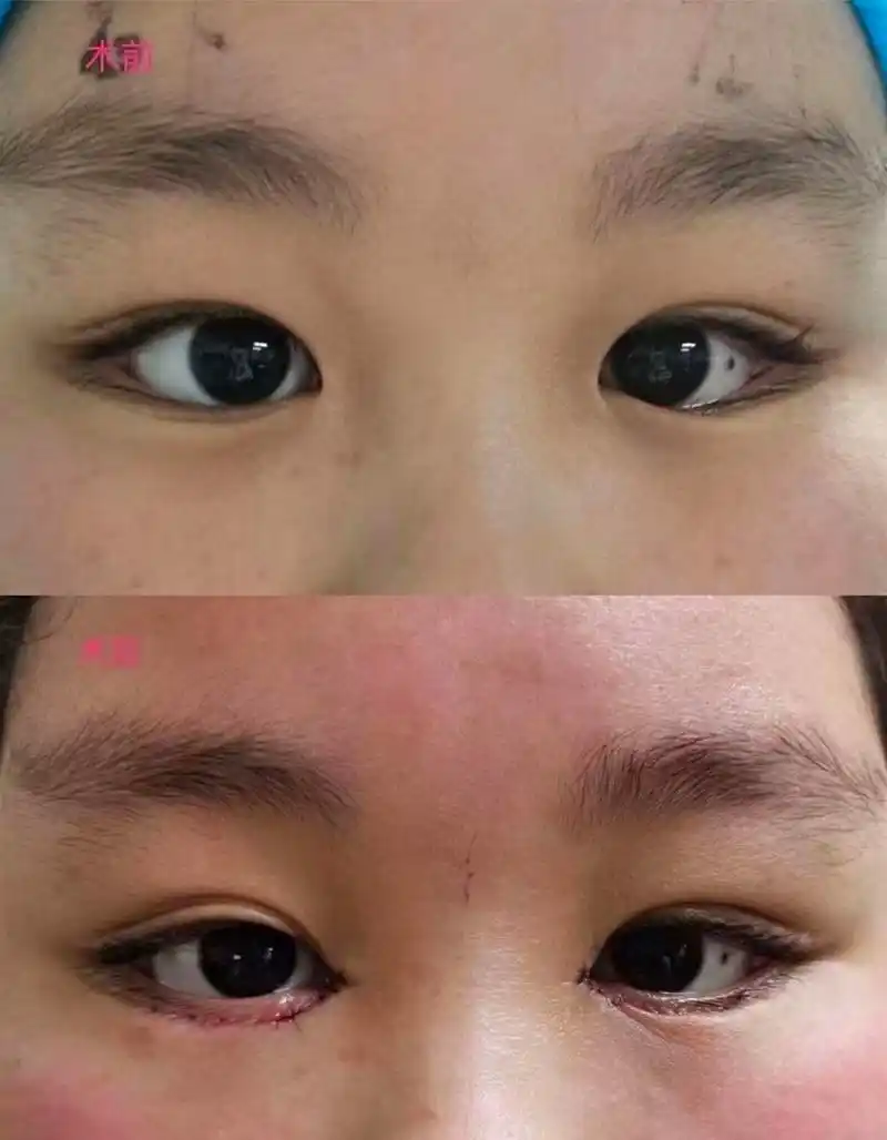 长了倒睫怎么办?  睫毛长到眼睛里面去了,这种情况就是倒睫,很常见.