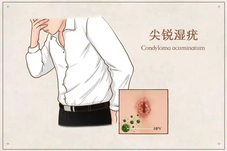 尖锐湿疣是由hpv感染之后在皮肤黏膜处局部增生长出菜花状赘生物,才能