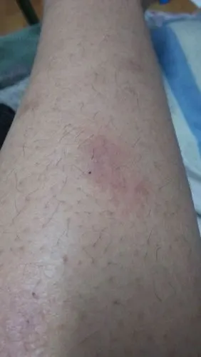 小腿上长的特别痒,皮肤有点硬,稍微发红这个是什么皮肤病