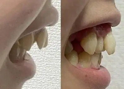 兔牙是龅牙吗?两分钟告诉你兔牙和龅牙的区别有哪些!-医秀网