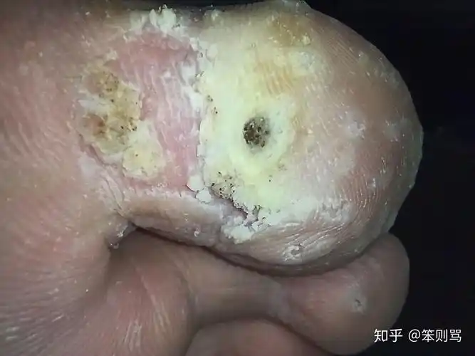 完全真实的跖疣好转过程,花费不到一百元!