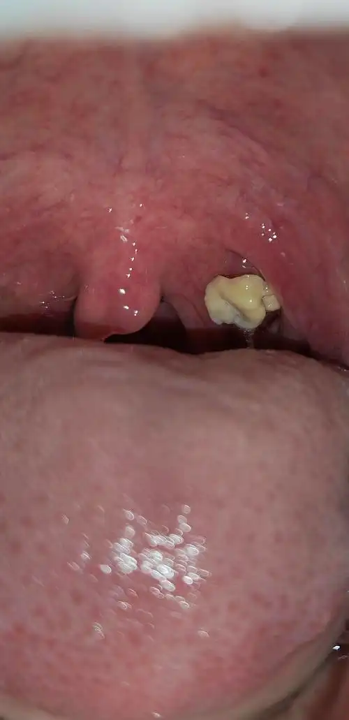 我竟然有扁桃体结石!!!